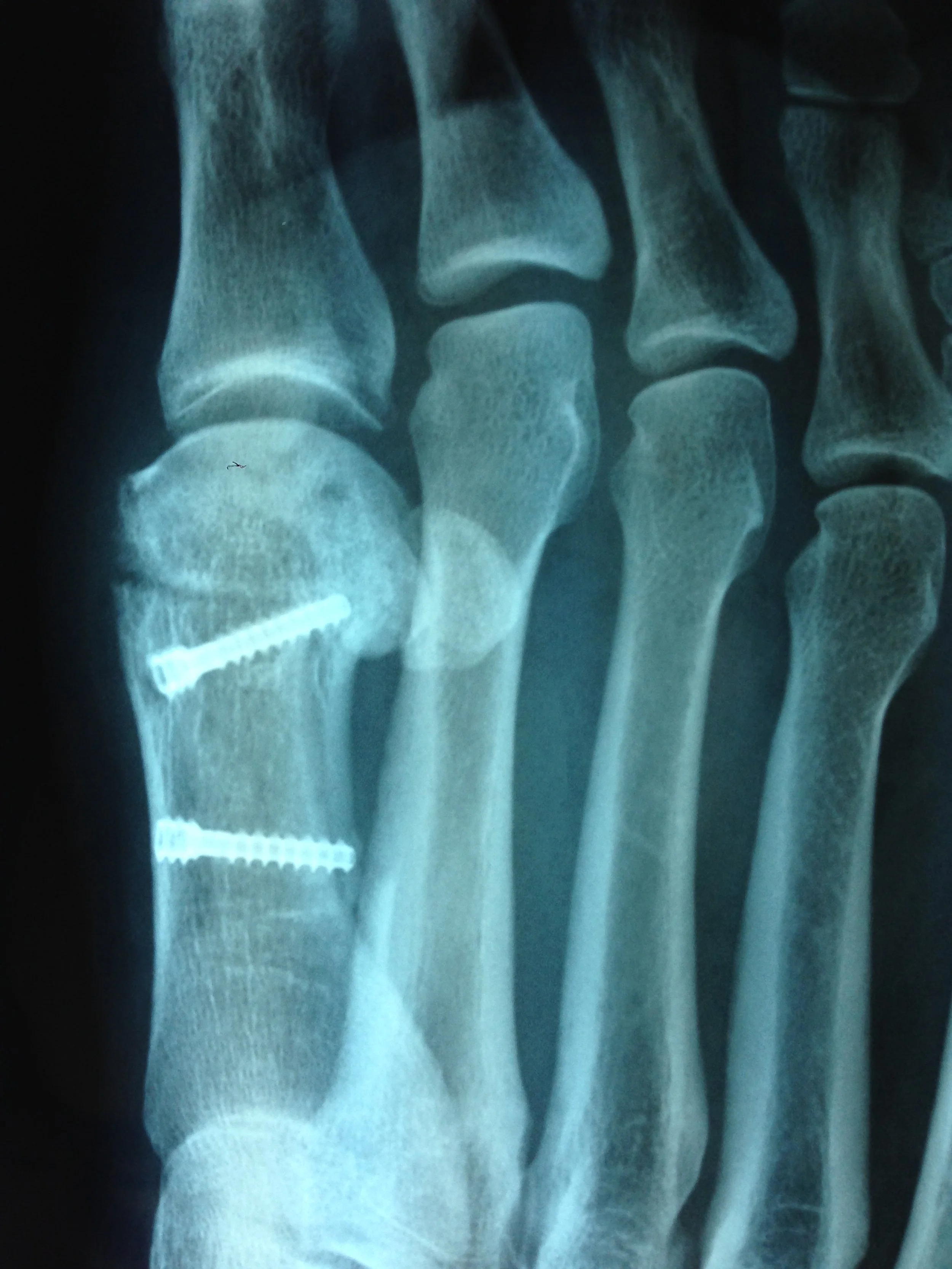 Foot X-ray published by Stupid Shoes director Dee Libine as part of the story behind the documentary